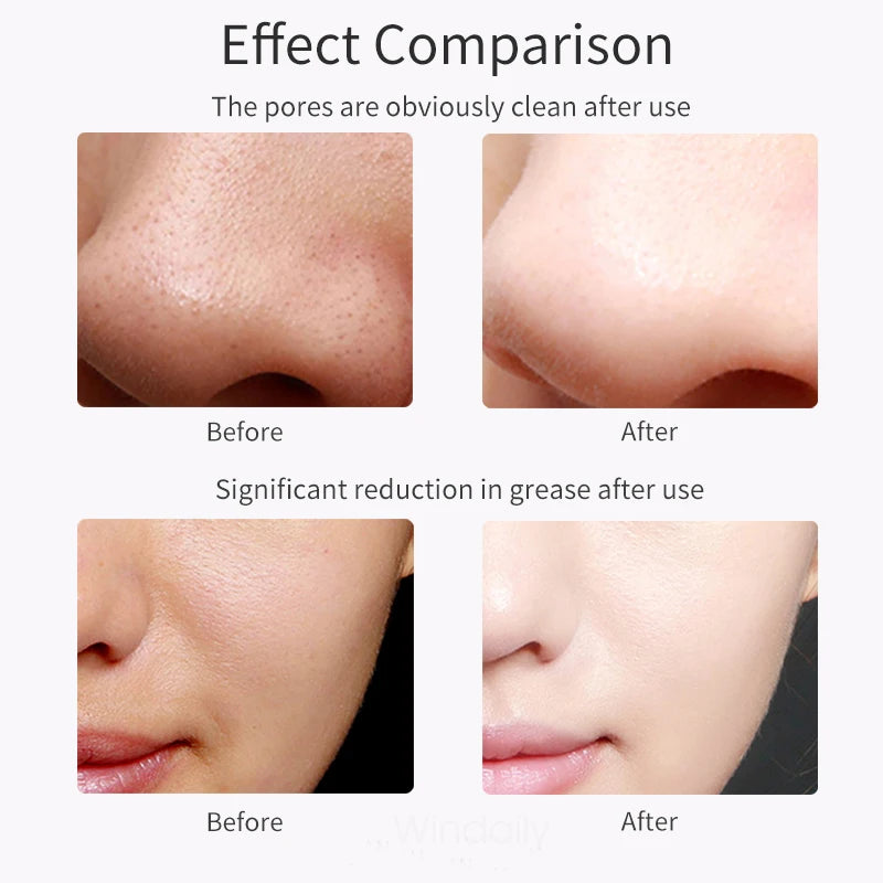 Ultrasonic Skin Scrubber | Blackhead Remover & Face Lifter